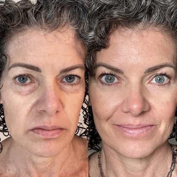 RevitalEyes® 2-in-1 Red Light Therapy + EMS To Erase Eye Bags